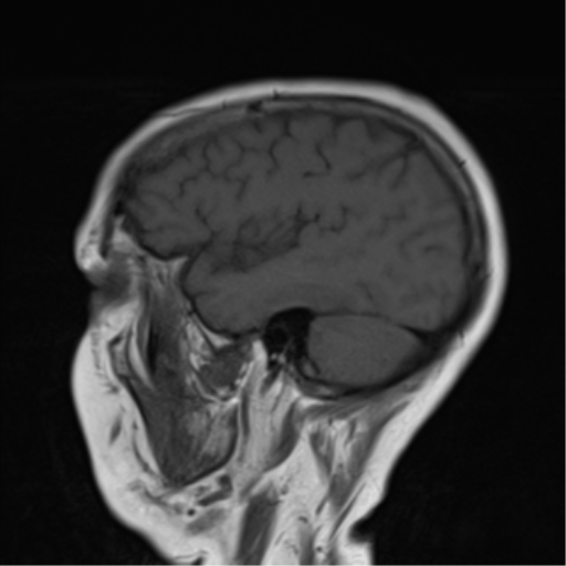File:Cerebellar metastasis (Radiopaedia 54578-60810 Sagittal T1 4).png