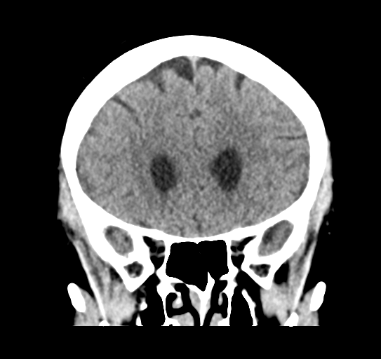 Cerebellar metastasis (Radiopaedia 54578-60812 Coronal non-contrast 17).png