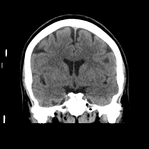 Cerebellar metastasis (cystic appearance) (Radiopaedia 41395-44258 Coronal non-contrast 29).png