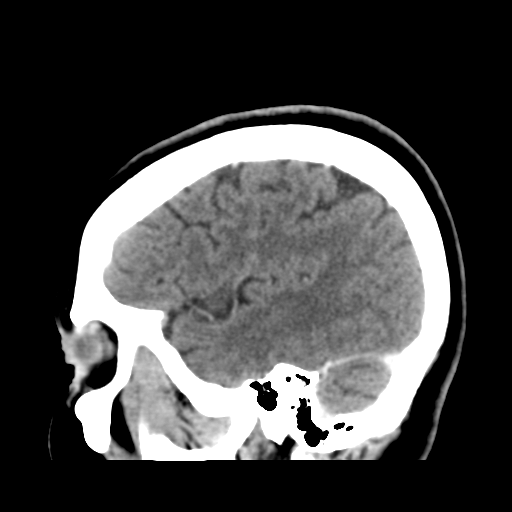 File:Cerebellar metastasis (cystic appearance) (Radiopaedia 41395-44258 F 41).png
