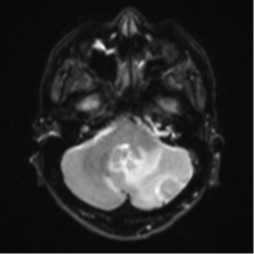 Cerebellar metastasis - adenocarcinoma lung (Radiopaedia 63184-71715 Axial DWI 7).png