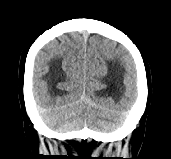 File:Cerebellar metastasis from lung adenocarcinoma (Radiopaedia 86690-102828 Coronal non-contrast 33).png