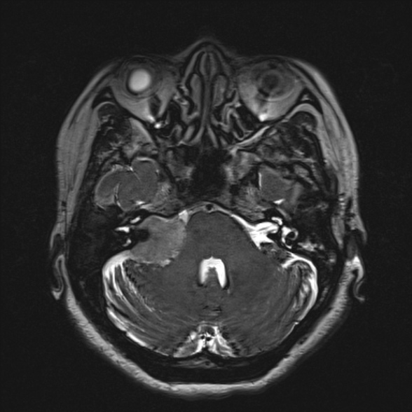 Cerebellopontine angle meningioma (Radiopaedia 53561-59591 Axial 3D volume T2 60).jpg