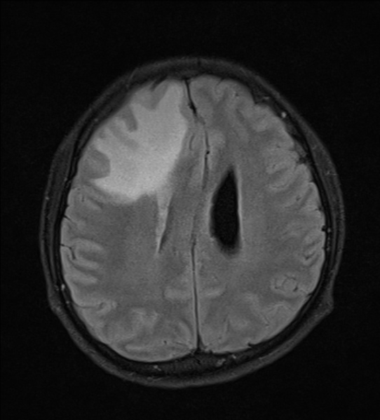 File:Cerebral abscess (Radiopaedia 24212-24478 Axial FLAIR 18).jpg