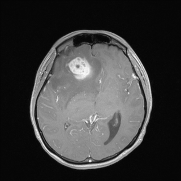 Cerebral abscess (Radiopaedia 24212-24478 Axial T1 C+ 31).jpg
