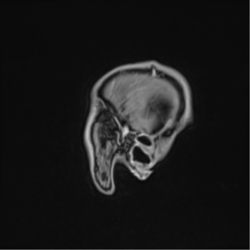 Cerebral abscess (Radiopaedia 60342-68009 J 52).png