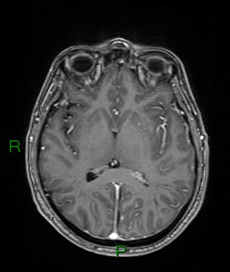 Cerebral abscess and subdural empyema (Radiopaedia 84436-99779 Axial T1 C+ 43).jpg