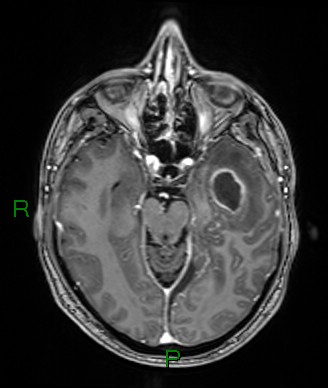 Cerebral abscess and subdural empyema (Radiopaedia 84436-99779 Axial T1 C+ 54).jpg
