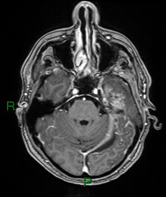 Cerebral abscess and subdural empyema (Radiopaedia 84436-99779 Axial T1 C+ 61).jpg
