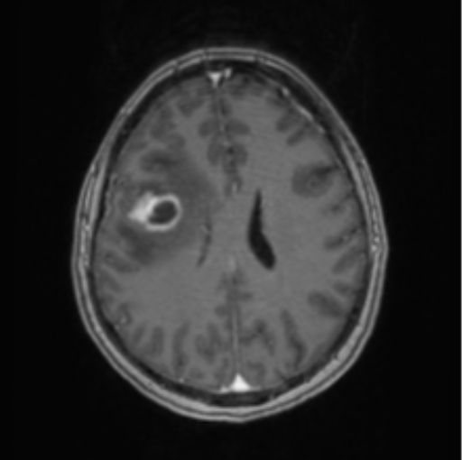 Cerebral abscess from pulmonary arteriovenous malformation (Radiopaedia 86275-102291 Axial T1 C+ 49).png
