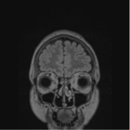 Cerebral abscess from pulmonary arteriovenous malformation (Radiopaedia 86275-102291 Coronal FLAIR 75).png