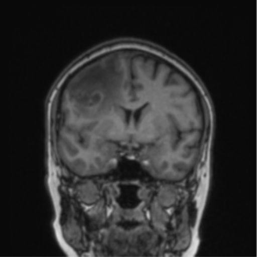 File:Cerebral abscess from pulmonary arteriovenous malformation (Radiopaedia 86275-102291 Coronal T1 54).png