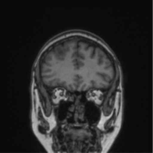Cerebral abscess from pulmonary arteriovenous malformation (Radiopaedia 86275-102291 Coronal T1 68).png