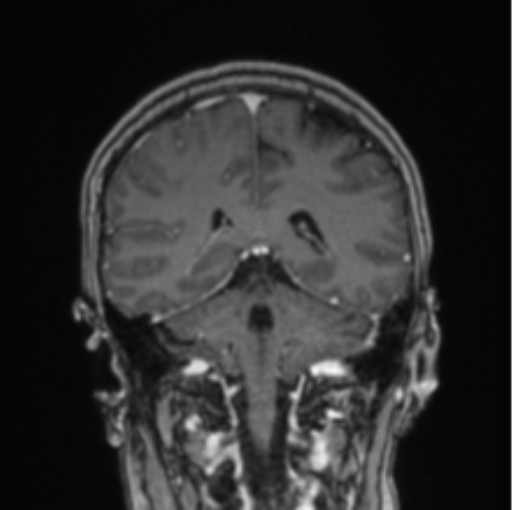 Cerebral abscess from pulmonary arteriovenous malformation (Radiopaedia 86275-102291 L 35).png