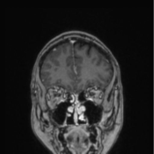 File:Cerebral abscess from pulmonary arteriovenous malformation (Radiopaedia 86275-102291 L 70).png