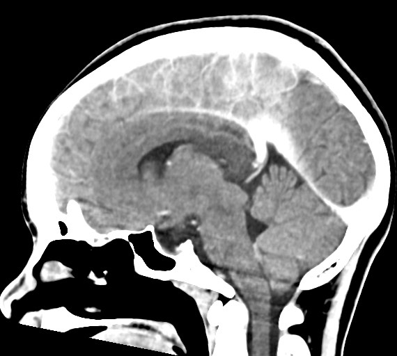 Cerebral abscesses (Radiopaedia 70458-80568 Sagittal Contrast 29).jpg
