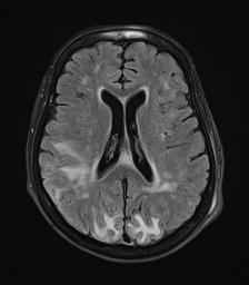 File:Cerebral amyloid angiopathy-related inflammation (Radiopaedia 74836-85849 Axial FLAIR 18).jpg