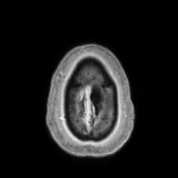 Cerebral amyloid angiopathy (Radiopaedia 29129-29518 Axial T1 C+ 144).jpg