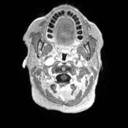 File:Cerebral amyloid angiopathy (Radiopaedia 29129-29518 Axial T1 C+ 5).jpg