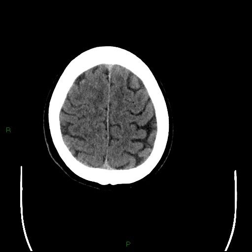 Cerebral amyloid angiopathy (Radiopaedia 77506-89665 Axial non-contrast 93).jpg