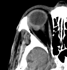 File:Cerebral and orbital tuberculomas (Radiopaedia 13308-13310 C 1).jpg