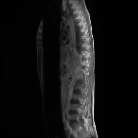 File:Cerebral and spinal tuberculosis (Radiopaedia 90489-107912 Sagittal T1 C+ 2).jpg
