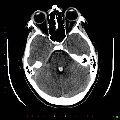 Cerebral arteriovenous malformation (AVM) (Radiopaedia 78162-90706 Axial non-contrast 21).jpg