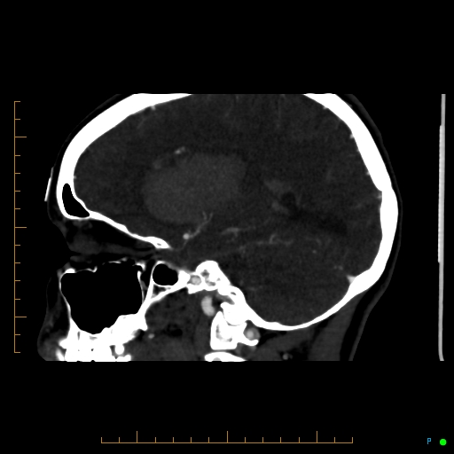 Cerebral arteriovenous malformation (AVM) (Radiopaedia 78162-90706 Sagittal CTA 32).jpg