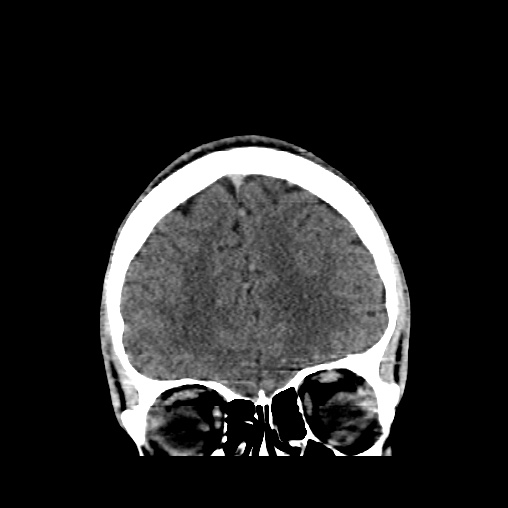 Cerebral arteriovenous malformation (Radiopaedia 61964-70028 Coronal non-contrast 14).jpg