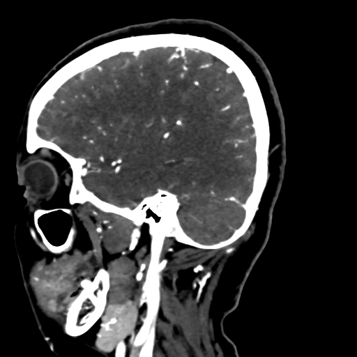File:Cerebral arteriovenous malformation (Radiopaedia 73830-84645 Sagittal C+ delayed 68).jpg