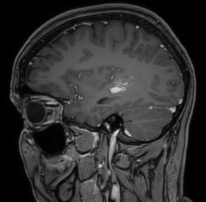 Cerebral arteriovenous malformation (Radiopaedia 74411-85654 Sagittal T1 C+ 36).jpg