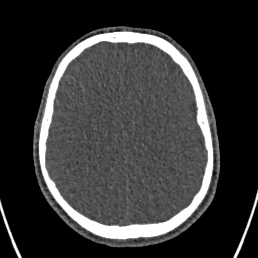 Cerebral arteriovenous malformation (Radiopaedia 78188-90746 Axial non-contrast 122).jpg