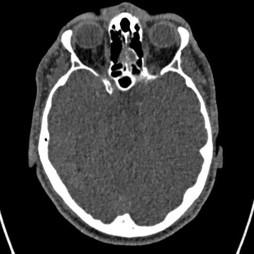 Cerebral arteriovenous malformation (Radiopaedia 78188-90746 Axial non-contrast 62).jpg