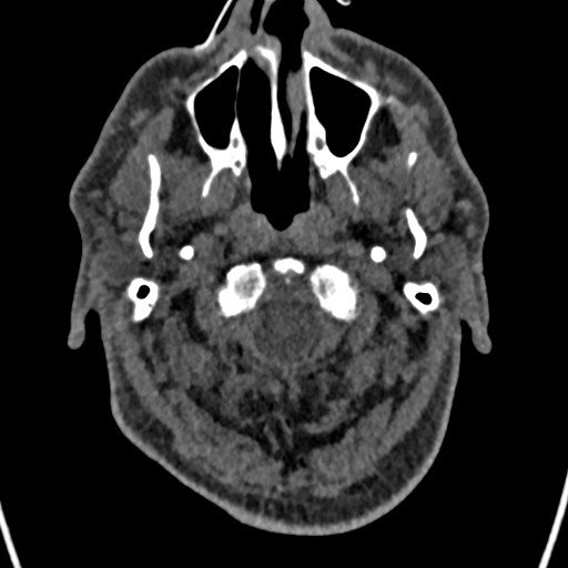 Cerebral arteriovenous malformation (Radiopaedia 78188-90746 Axial non-contrast 9).jpg
