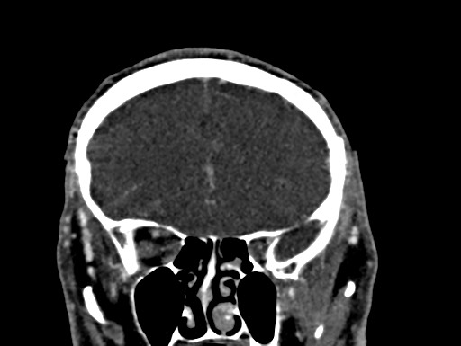 File:Cerebral arteriovenous malformation (Radiopaedia 78188-90746 Coronal C+ delayed 28).jpg