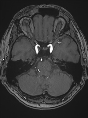 File:Cerebral arteriovenous malformation (Radiopaedia 84015-99245 Axial TOF 79).jpg