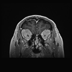 Cerebral arteriovenous malformation (Radiopaedia 84015-99245 Coronal T1 C+ 33).jpg