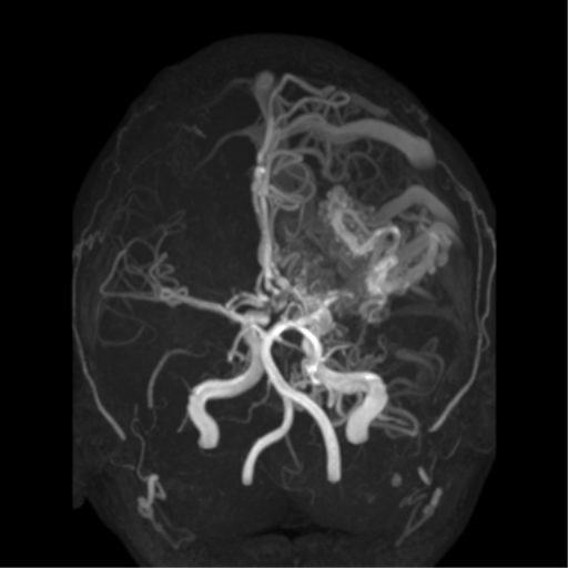 File:Cerebral arteriovenous malformation - huge (Radiopaedia 35734-37272 MRA 3).png