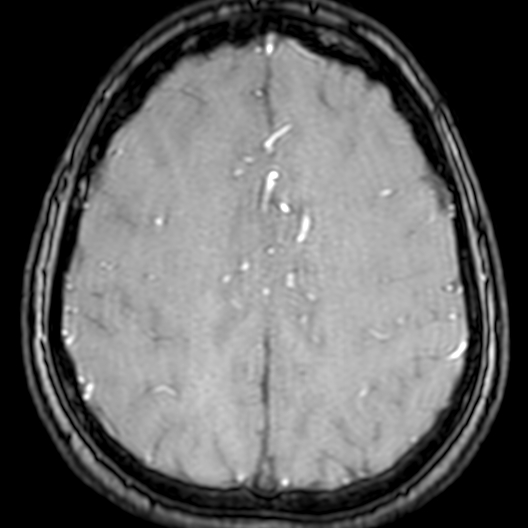 Cerebral arteriovenous malformation at posterior body of corpus callosum (Radiopaedia 74111-84925 Axial MRA 165).jpg