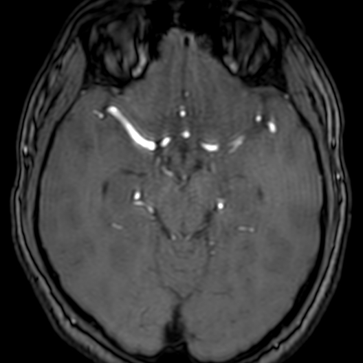 Cerebral arteriovenous malformation at posterior body of corpus callosum (Radiopaedia 74111-84925 Axial MRA 83).jpg