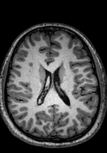 Cerebral arteriovenous malformation at posterior body of corpus callosum (Radiopaedia 74111-84925 Axial T1 113).jpg