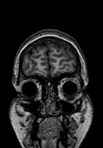 Cerebral arteriovenous malformation at posterior body of corpus callosum (Radiopaedia 74111-84925 Coronal T1 13).jpg