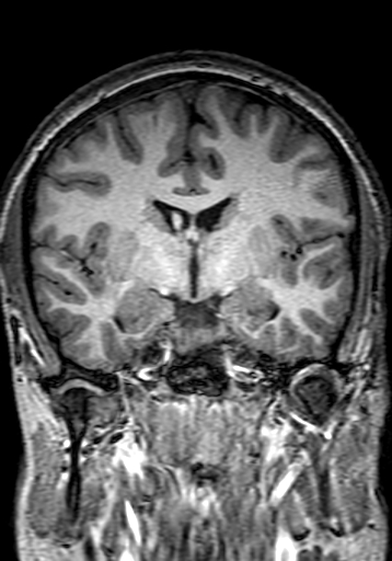 File:Cerebral arteriovenous malformation at posterior body of corpus callosum (Radiopaedia 74111-84925 Coronal T1 148).jpg