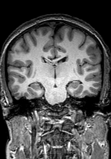 Cerebral arteriovenous malformation at posterior body of corpus callosum (Radiopaedia 74111-84925 Coronal T1 179).jpg