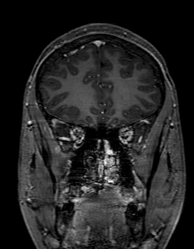 Cerebral arteriovenous malformation at posterior body of corpus callosum (Radiopaedia 74111-84925 K 86).jpg