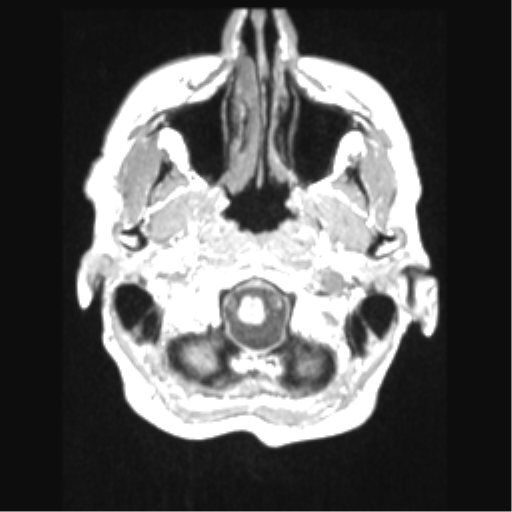 File:Cerebral arteriovenous malformation with hemorrhage (Radiopaedia 34422-35737 Axial T1 8).png