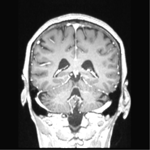 Cerebral arteriovenous malformation with hemorrhage (Radiopaedia 34422-35737 Coronal T1 C+ 34).png