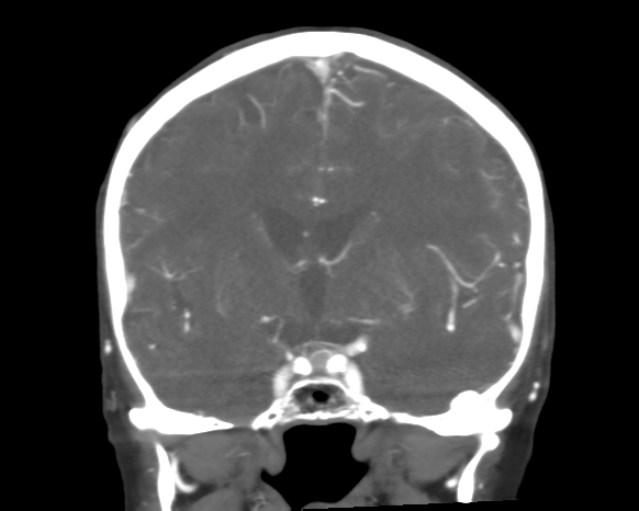 File:Cerebral arteriovenous malformation with lobar hemorrhage (Radiopaedia 44725-48511 A 28).png