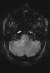 File:Cerebral cavernoma and development venous anomaly (Radiopaedia 37603-39482 Axial SWI 8).png