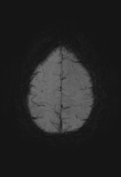 File:Cerebral cavernoma and development venous anomaly (Radiopaedia 37603-39482 Axial SWI MIP 28).png